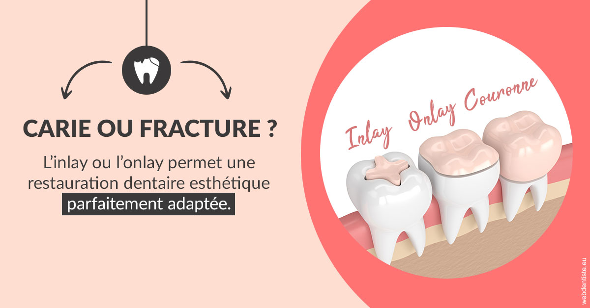 https://dr-laupie-julien.chirurgiens-dentistes.fr/T2 2023 - Carie ou fracture 2