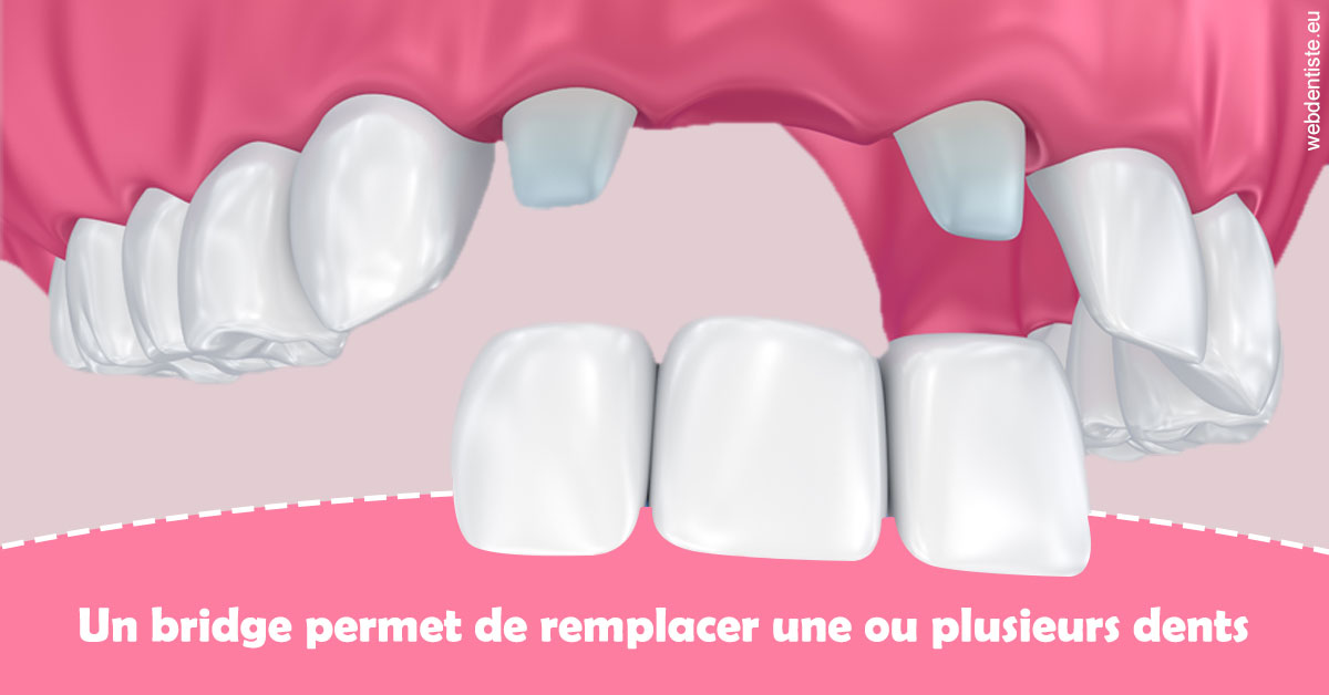 https://dr-laupie-julien.chirurgiens-dentistes.fr/Bridge remplacer dents 2