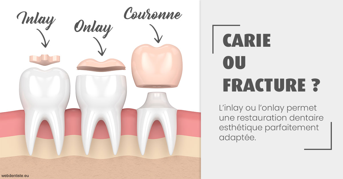 https://dr-laupie-julien.chirurgiens-dentistes.fr/T2 2023 - Carie ou fracture 1