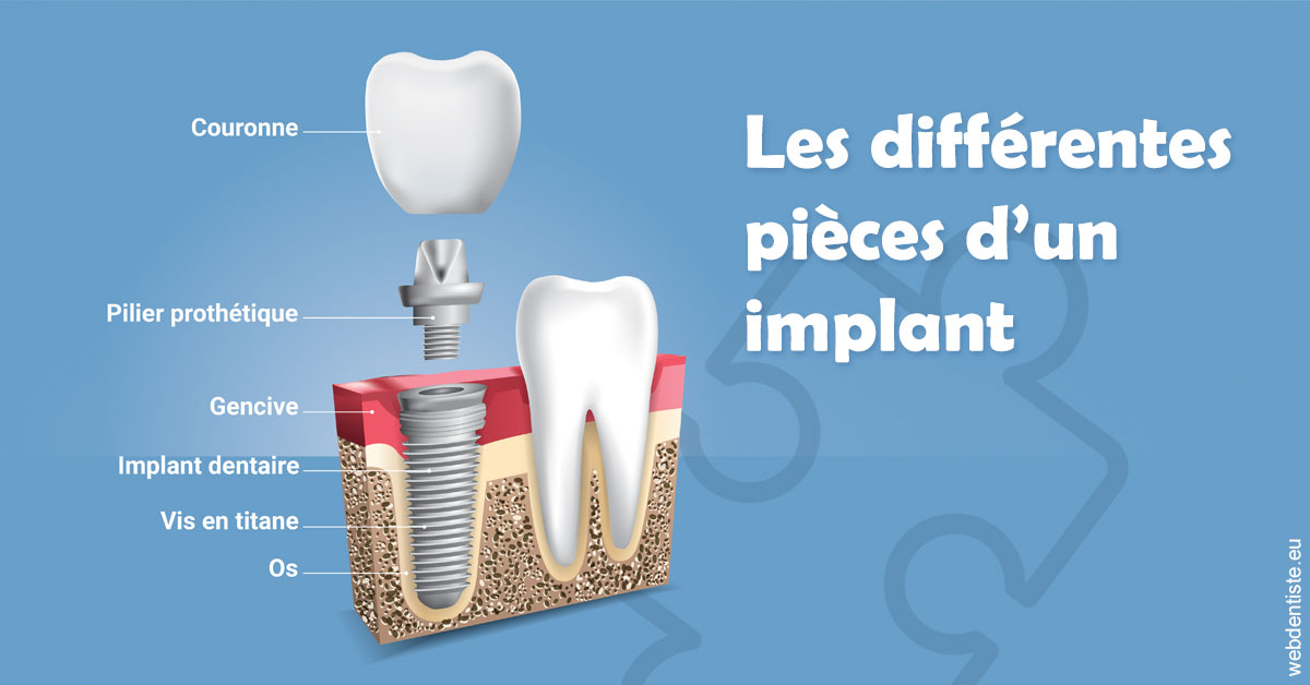 https://dr-laupie-julien.chirurgiens-dentistes.fr/Les différentes pièces d’un implant 1
